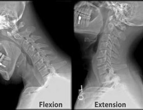 Cervical_XRayFlexionExtension