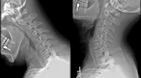 Cervical_XRayFlexionExtension