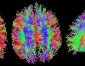 Hersenen-MRI_pixabay
