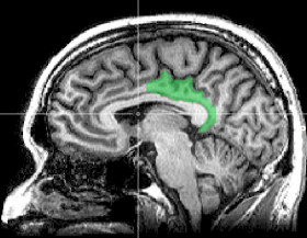 MRI_posterior_cingulate