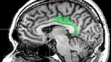 MRI_posterior_cingulate