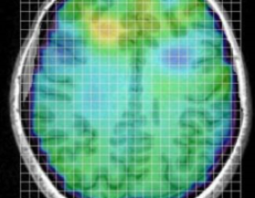 Neuro-inflammatie-hersenen