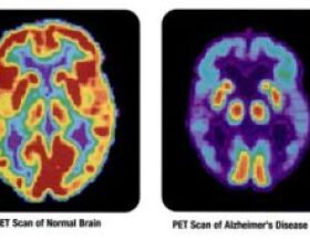 PETscan-normal_brain-alzheimer