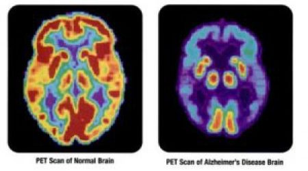 PETscan-normal_brain-alzheimer