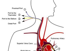 Pulmonary_artery_catheter_Wikipedia