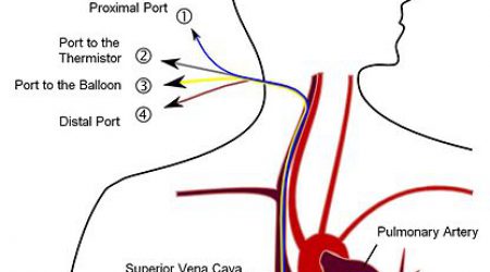 Pulmonary_artery_catheter_Wikipedia