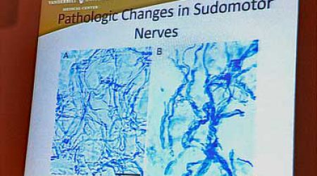 Small-Fiber-Neuropathy